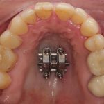 Boca con el tornillo de expansión del paladar