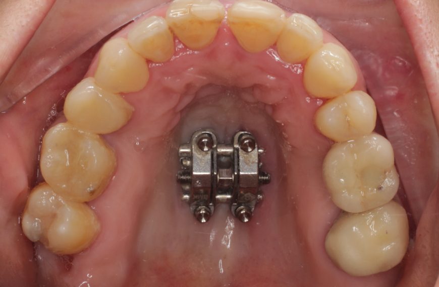Boca con el tornillo de expansión del paladar