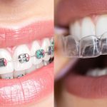 Ortodoncia invisible vs brackets: comparación clínica