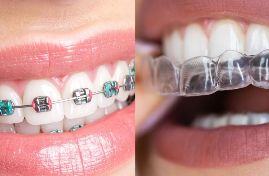 Ortodoncia invisible vs brackets: comparación clínica